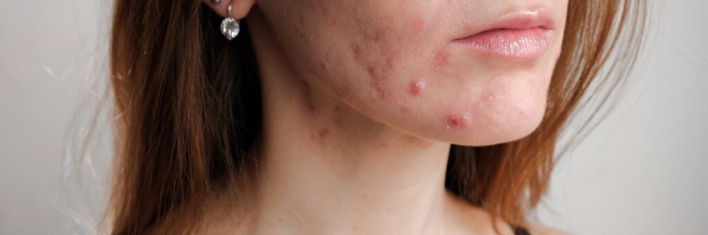 Les causes de l’acné