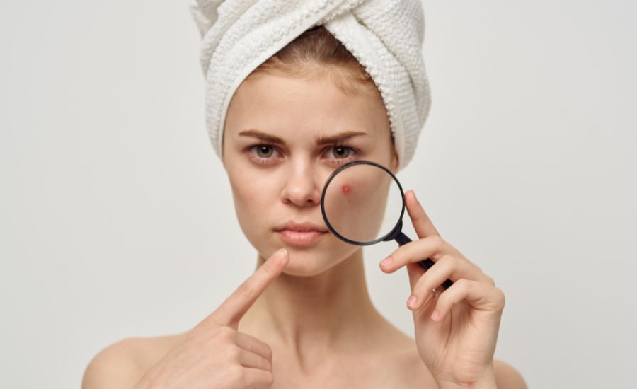 Conseils pratiques pour lutter contre l'acné et les imperfections de la peau
