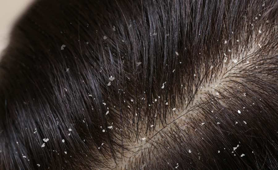 Argile, vinaigre de cidre, bicarbonate et shampooing clarifiant forment un protocole de détox capillaire naturel complet.